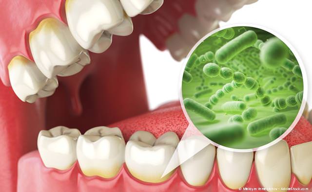 Parodontologie bei Zahnfleischentzündungen, Zahnlockerungen